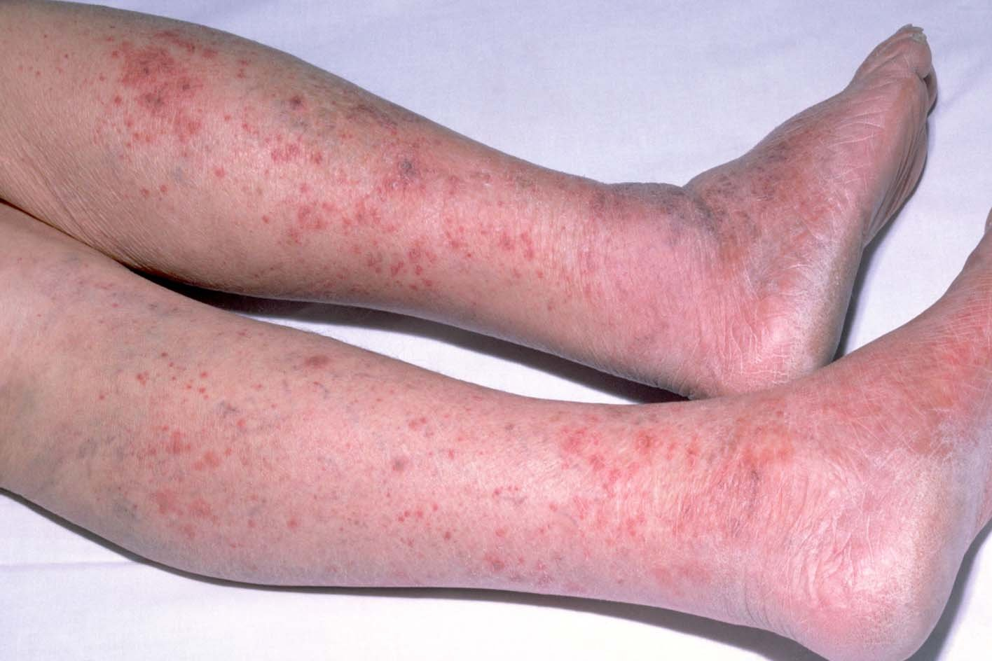 Complement Deposit Rash FRCEMSecrets.co.uk Bank of SBA questions